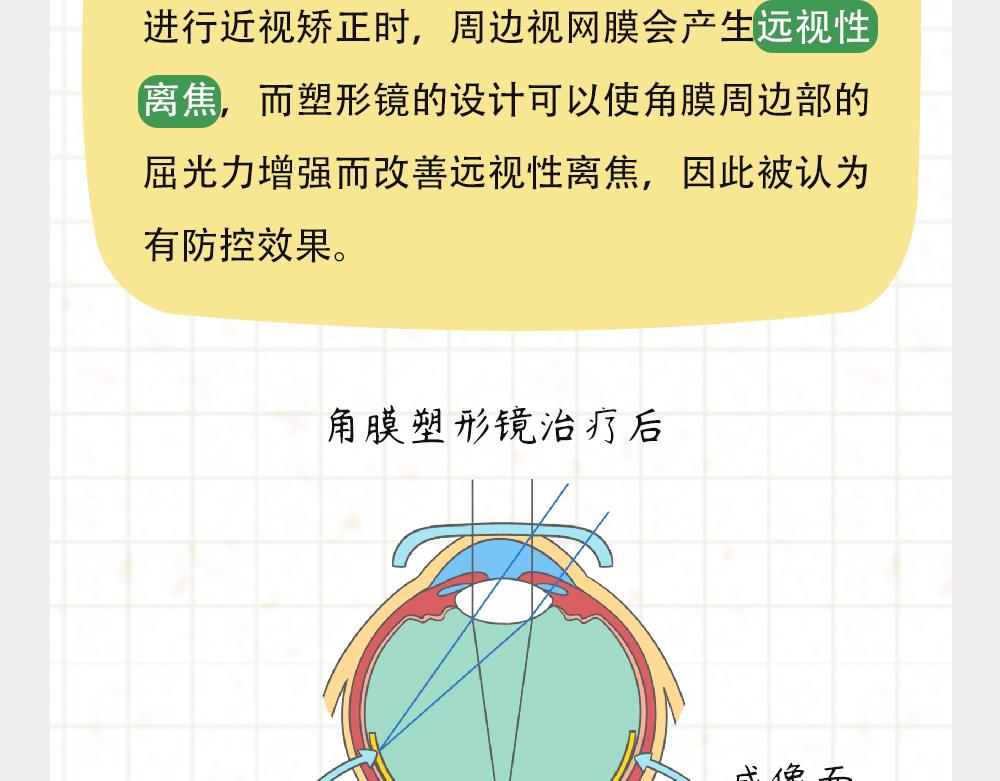 《漫话隐形眼镜》戴框架眼镜的烦恼（下） 第33页