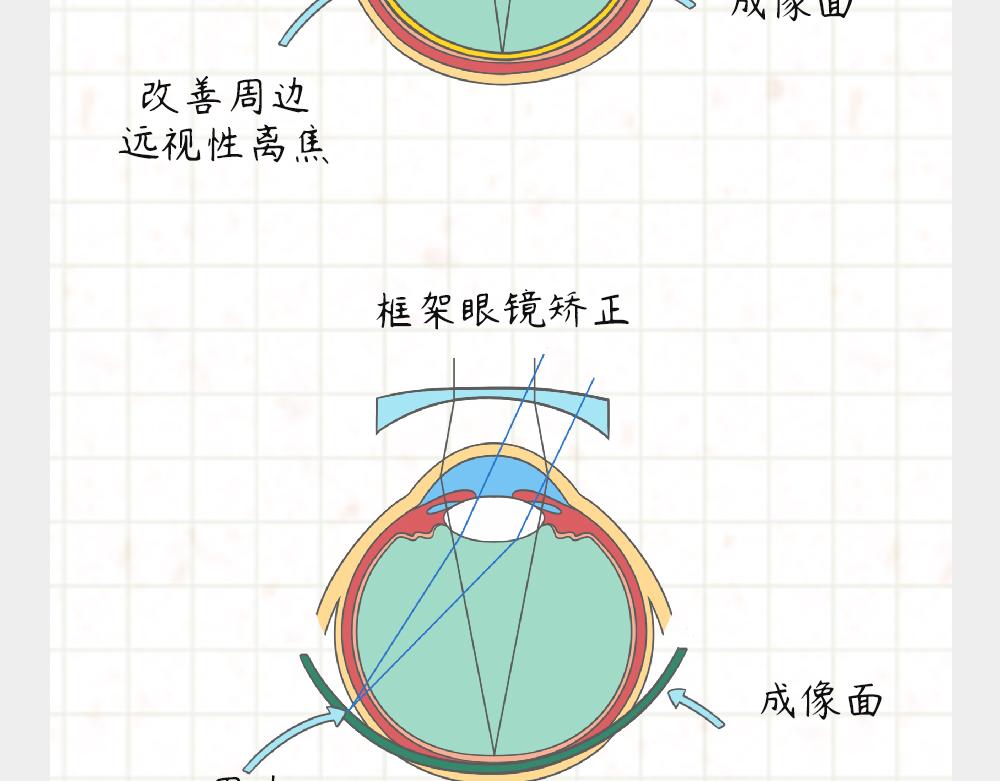 《漫话隐形眼镜》戴框架眼镜的烦恼（下） 第34页